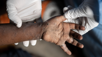 Criança com sinais de mpox em Goma, na República Democrática do Congo. Foto: Michel Lunanga