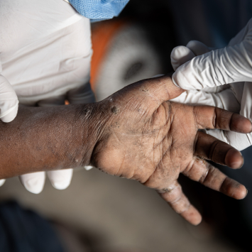 Criança com sinais de mpox em Goma, na República Democrática do Congo. Foto: Michel Lunanga